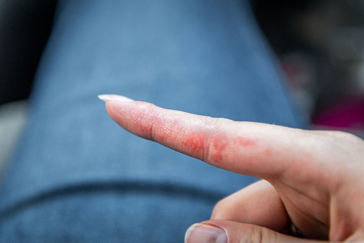 Czerwony ślad po łańcuszku lub pierścionku? To może być alergia. Jak objawia się uczulenie na nikiel?