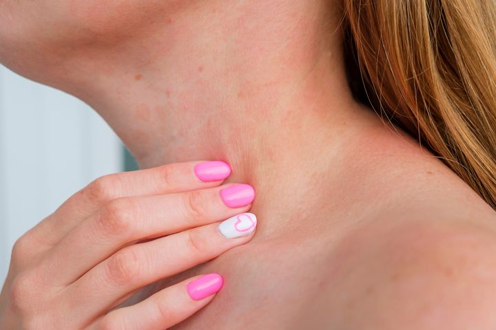 Swędząca wysypka na szyi może mieć różne przyczyny