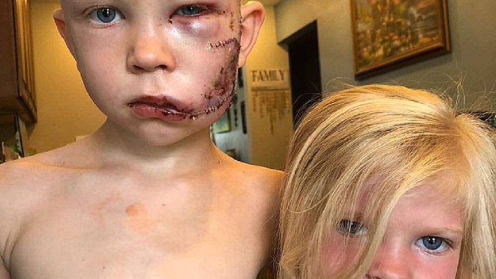 6-latkowi założono 90 szwów