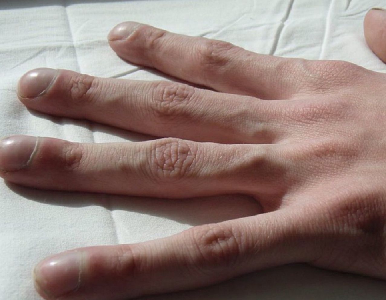 Ten znak na dłoniach to dowód, że rak jest zaawansowany