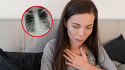 Zapalenie płuc groźniejsze niż się wydaje. "Czasem ujawnia nowotwór"