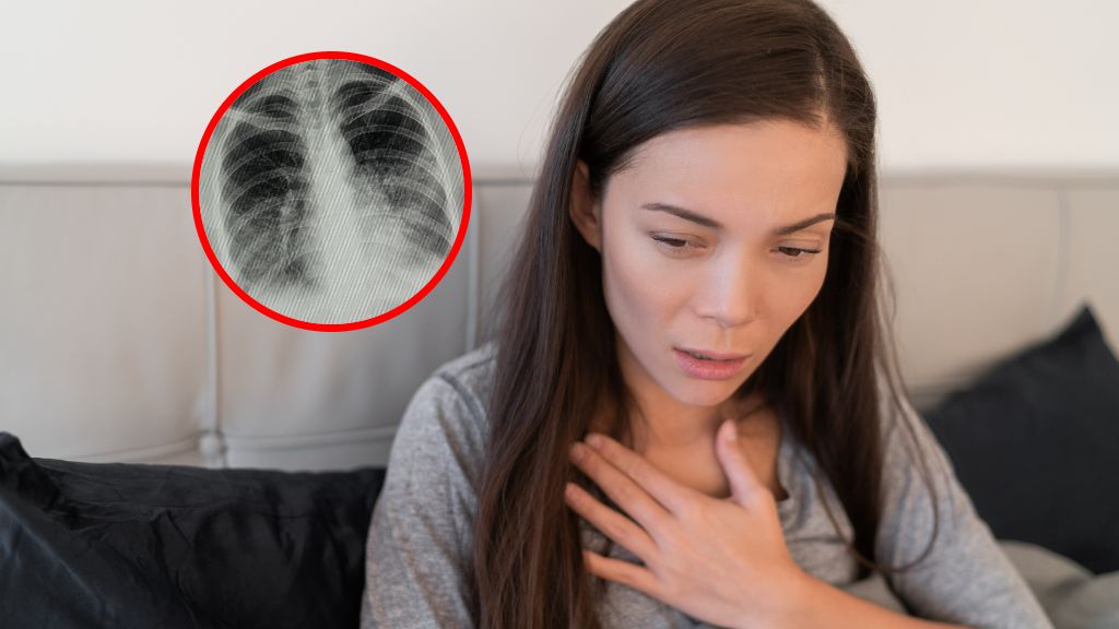 Zapalenie płuc nie jest łagodną chorobą. Lekarka ostrzega