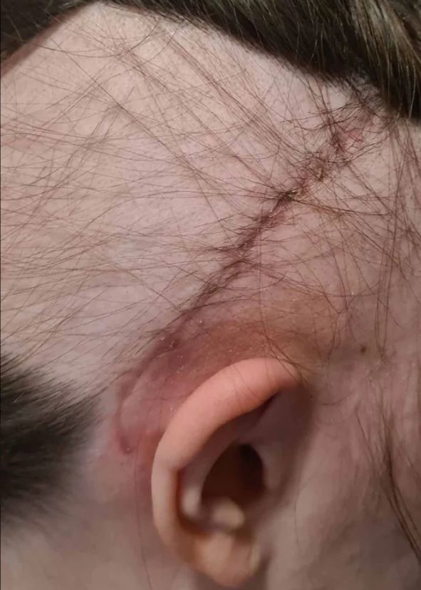 Mimo zapewnień lekarza konieczne było usunięcie guza