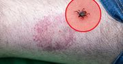 Niebezpieczny wirus przenoszony przez kleszcze. Potwierdzono pierwszy przypadek w Wielkiej Brytanii