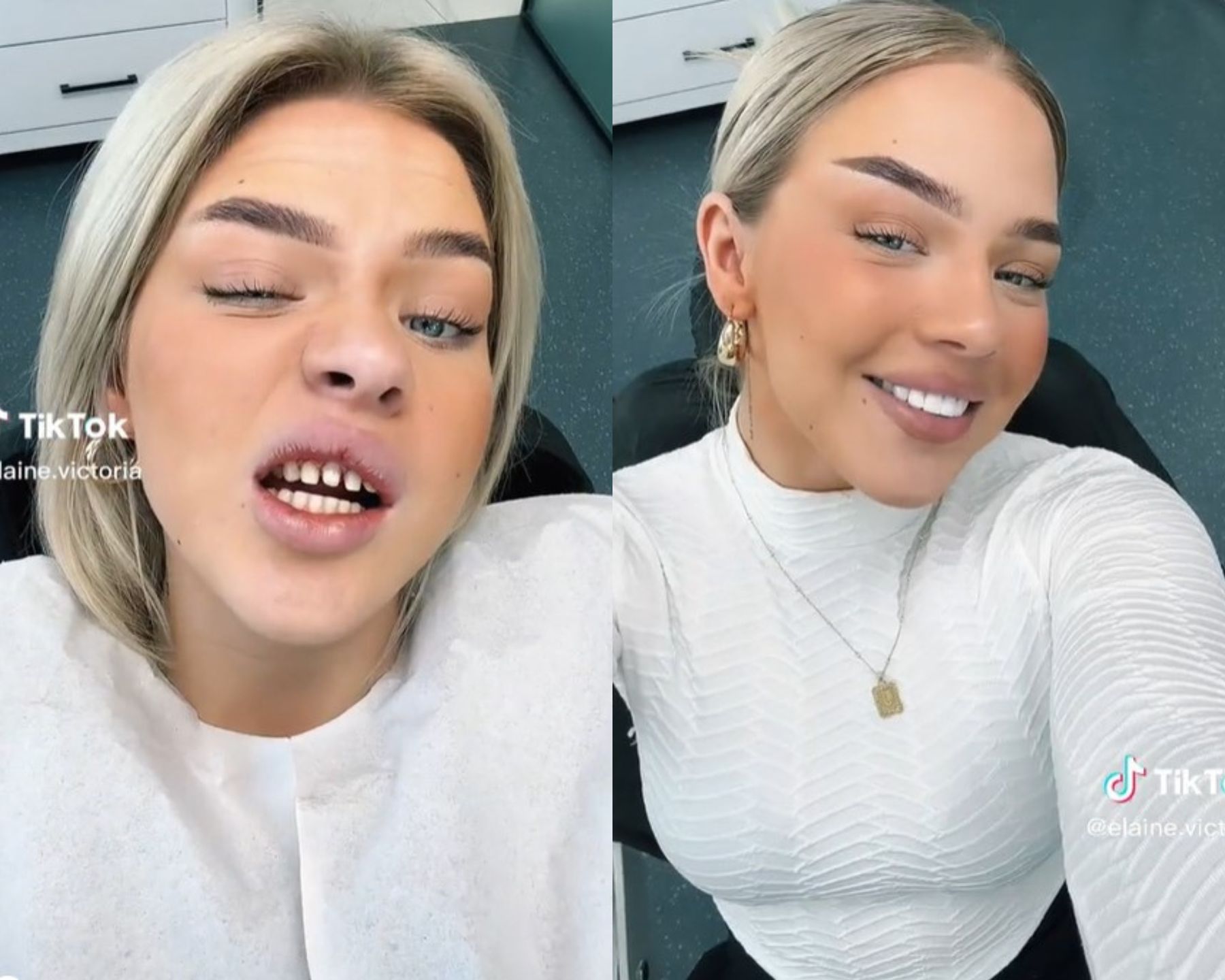 Zdjęcie jej zębów przed i po zabiegu. 