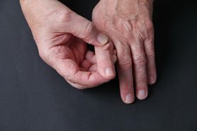 Bywa mylona z reumatyzmem. Drętwienie dłoni jest pierwszym objawem