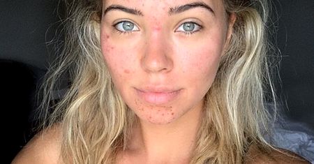 #Wszechmocne. Sandra Kubicka od lat zmaga się z PCOS. "Uśmiechałam się do zdjęć, a w środku wyłam z rozpaczy"