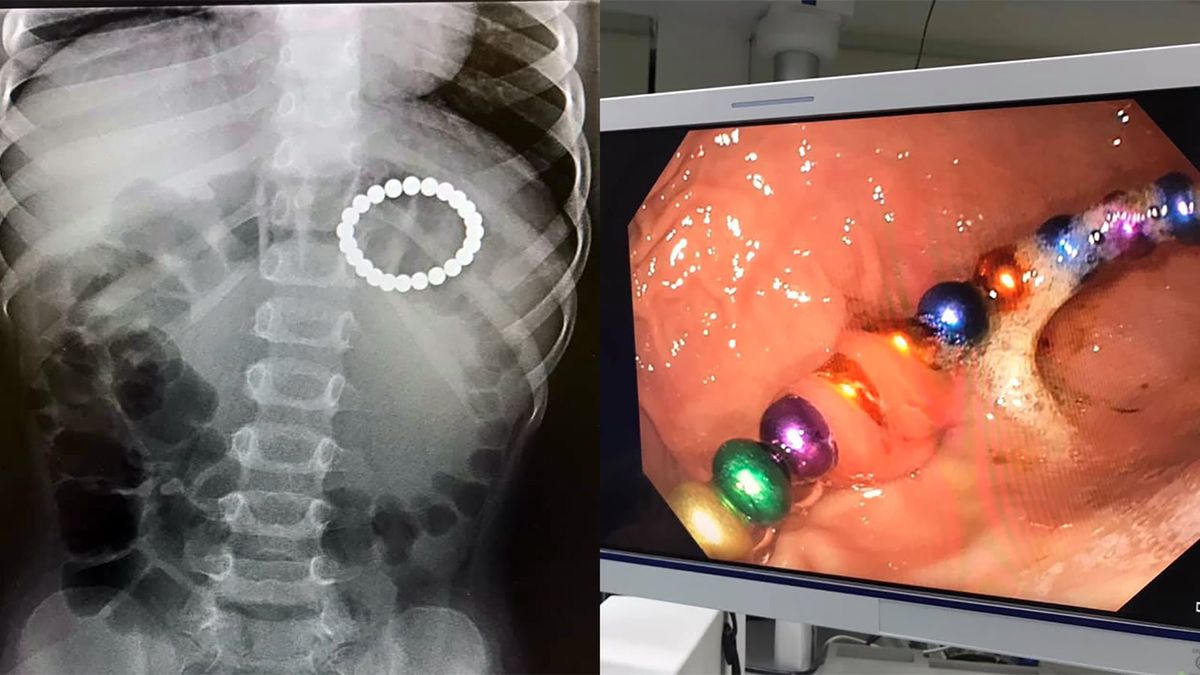Lekarze znaleźli kulki magnetyczne w brzuchu kolejnego dziecka