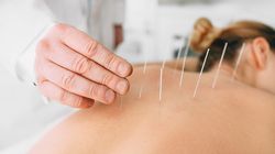 Punkty akupunktury - mapa, znaczenie i efekty akupunktury