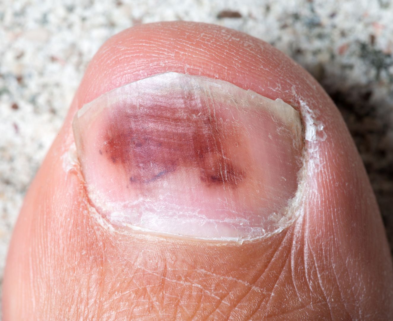 Wygląd stóp i paznokci może wskazywać na poważne choroby