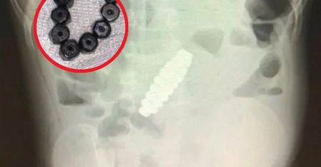 4-latek skarżył się na ból brzucha. Lekarze byli w szoku, gdy sprawdzili jego jelita