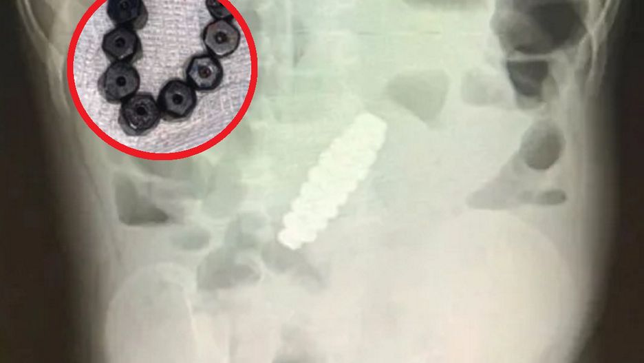 4-latek skarżył się na ból brzucha. Lekarze byli w szoku, kiedy odkryli powód