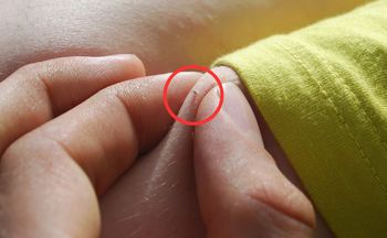 Ludzie myślą, że to pieprzyki. Równie groźne jak kleszcze