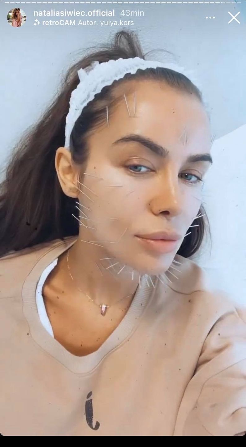 Natalia Siwiec z twarzą NAKŁUTĄ IGŁAMI relacjonuję wizytę w klinice medycyny estetycznej