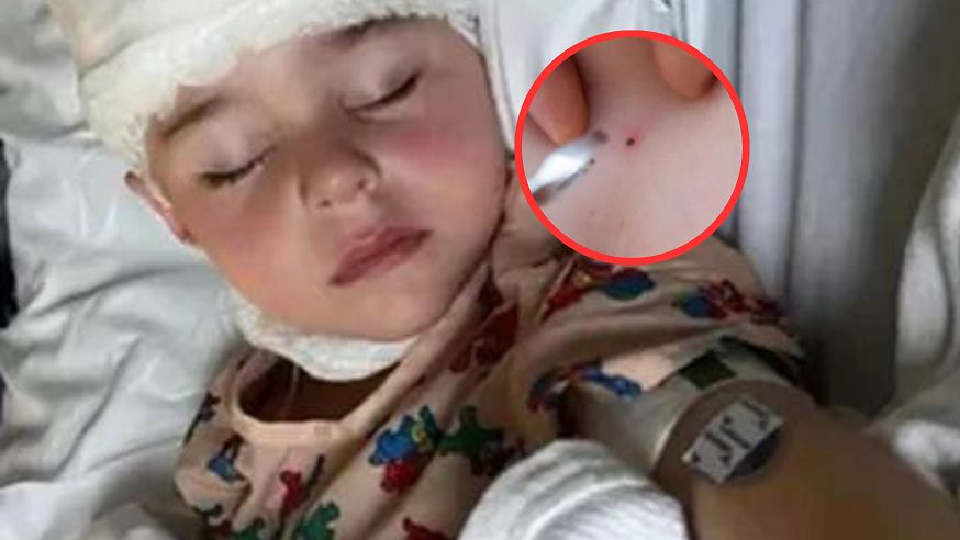 Mama sama usunęła kleszcza. Teraz ostrzega