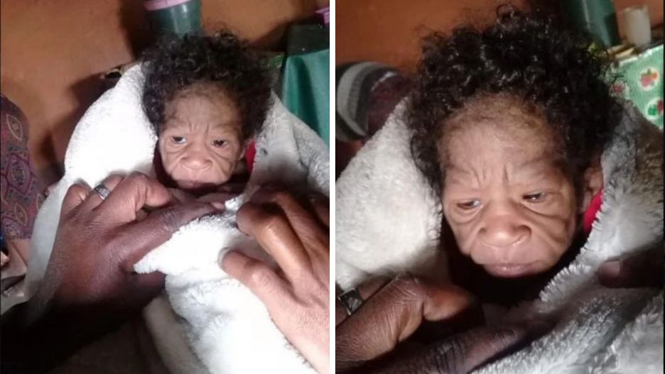 Niemowlę wygląda jak starzec. Urodziło się z rzadką chorobą genetyczną