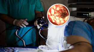 Preludium do raka jelita grubego. Ryzyko rośnie pięciokrotnie