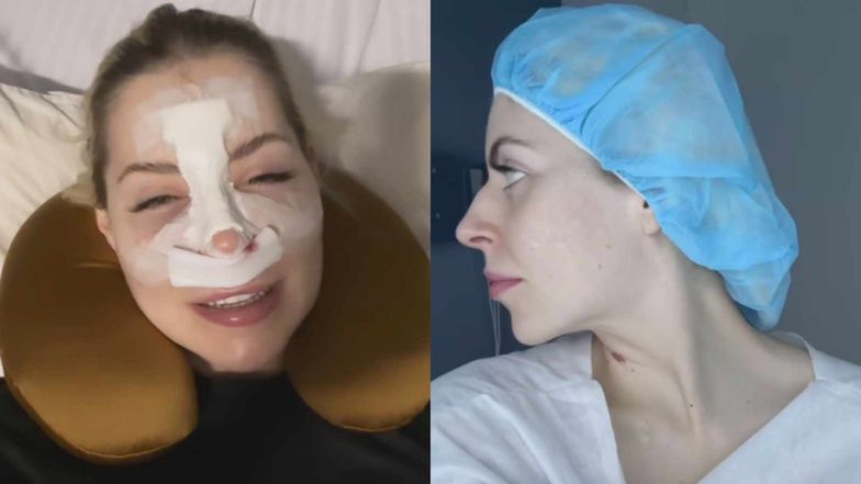 Julia von Stein po operacji nosa