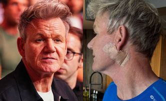 Gordon Ramsay poinformował, że zdiagnozowano u niego RAKA SKÓRY. Kucharz miał zabieg: "Obiecuję, że to nie LIFTING"