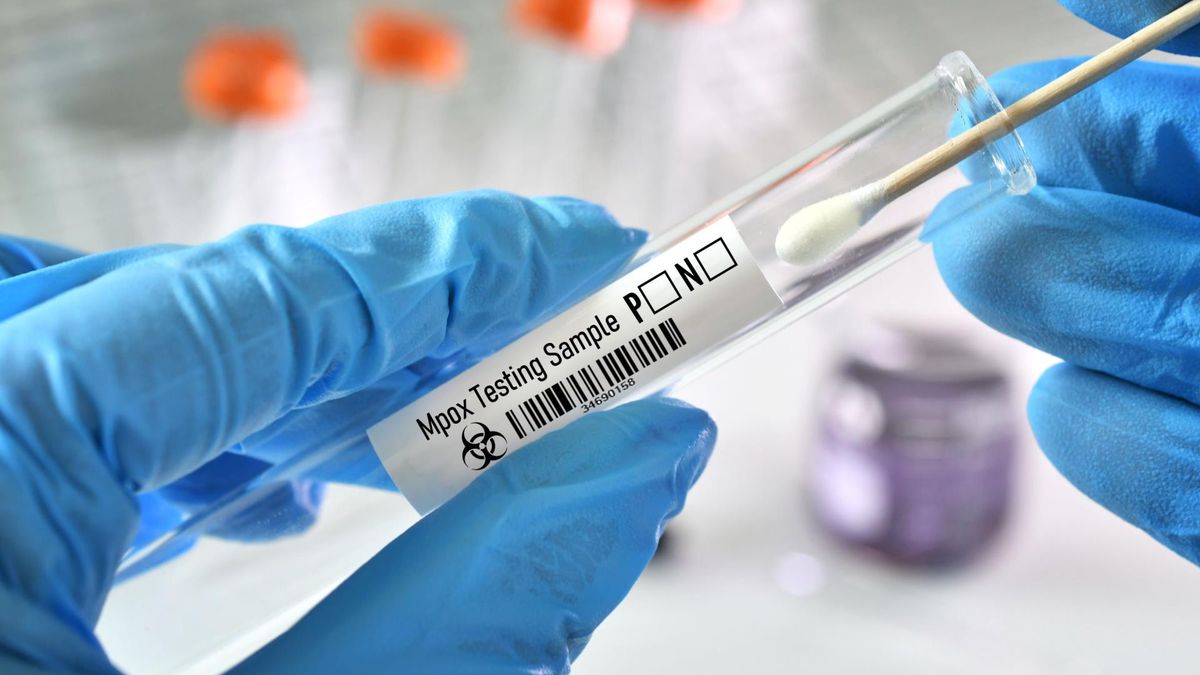 Wykryto nową odmianę wirusa "małpiej ospy" w Wielkiej Brytanii