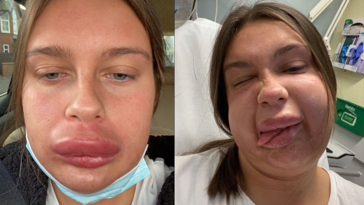 Koszmarny efekt powiększania ust