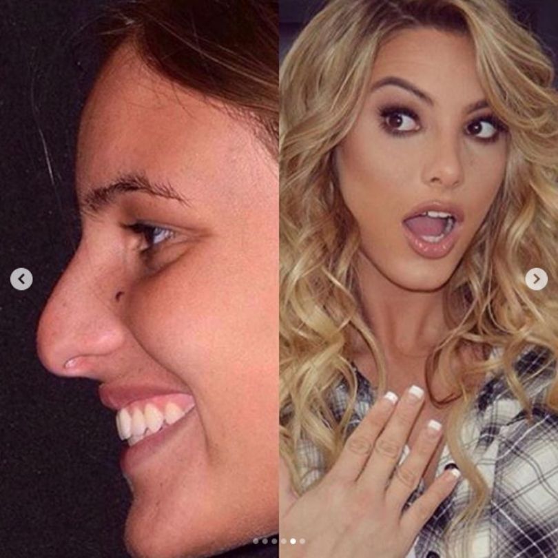 Chirurg plastyczny zaprezentował metamorfozę Lele Pons
