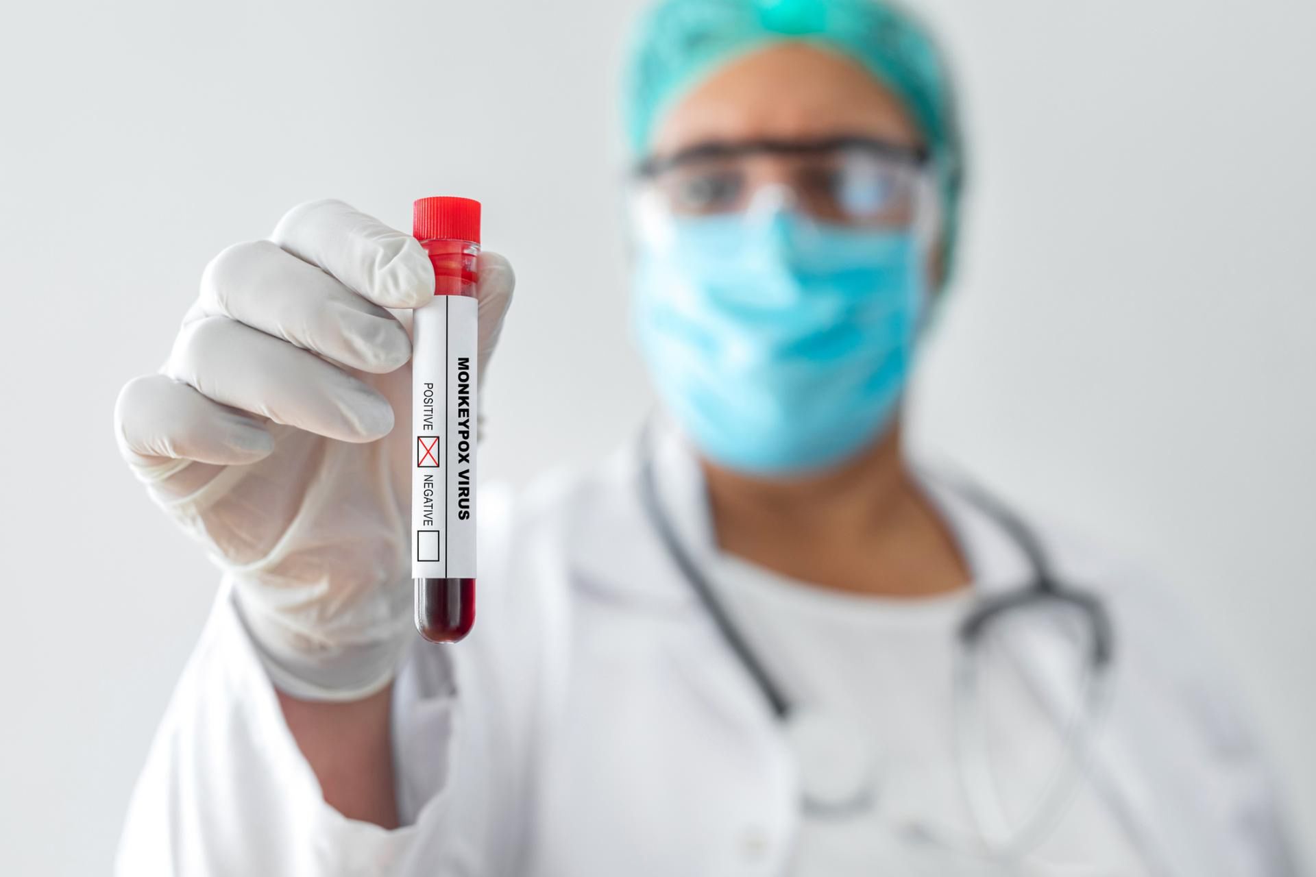 Testy na małpią ospę będą wykonywane w laboratorium PZH