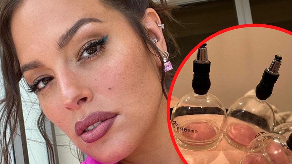 Modelka w ciąży postawiła sobie "bańki". Dr Krajewska ostro komentuje