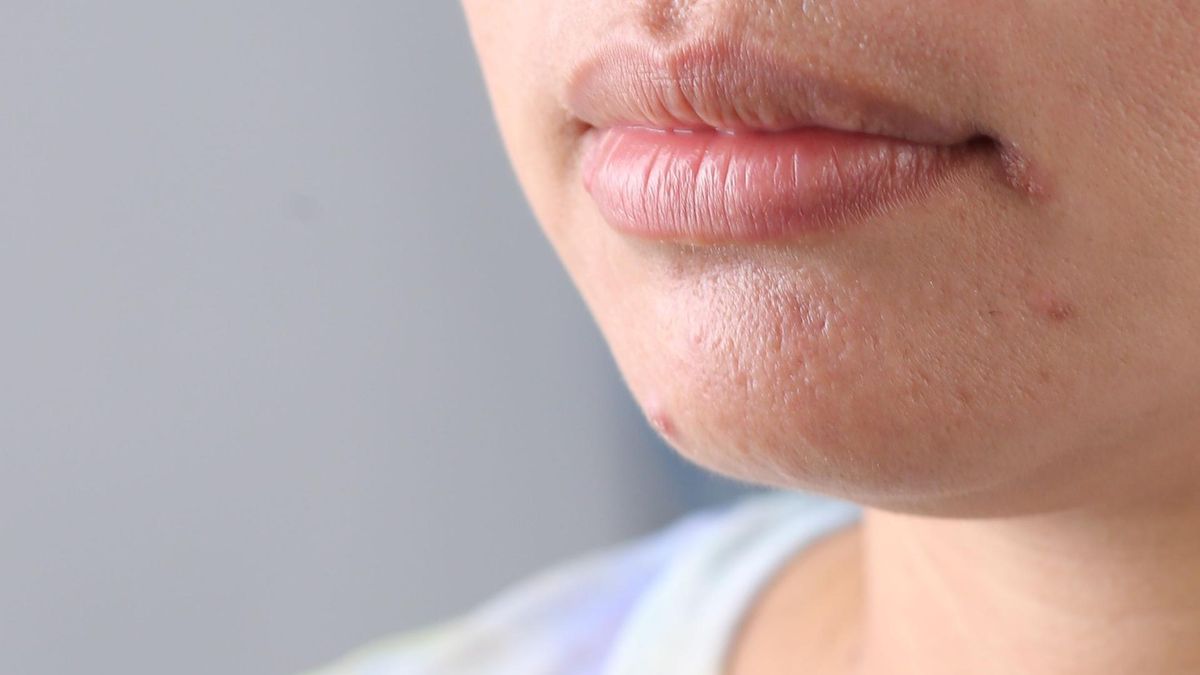 Zapalenie kątów ust, bo tak inaczej nazywa się zajady, zaczyna się pęknięciem suchej skóry wokół ust.