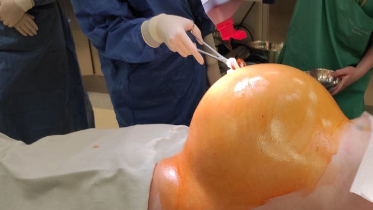 W organizmie pacjentki wyrósł guz ważący aż 30 kilogramów