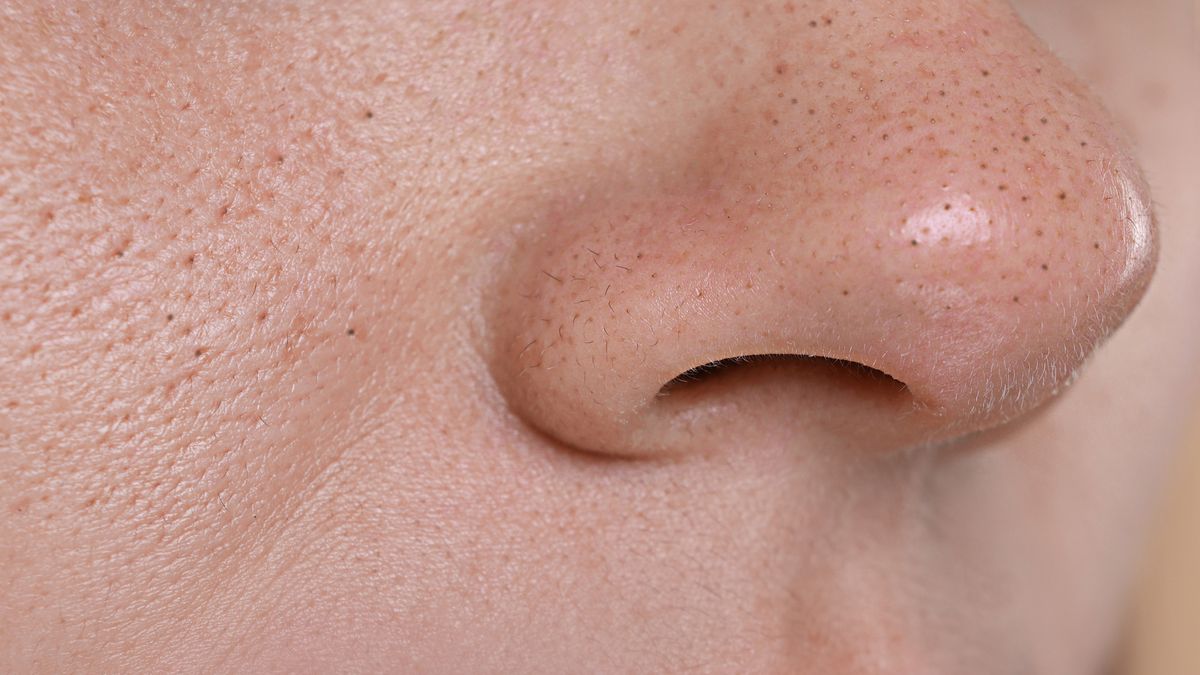 Jak pozbyć się wągrów? 