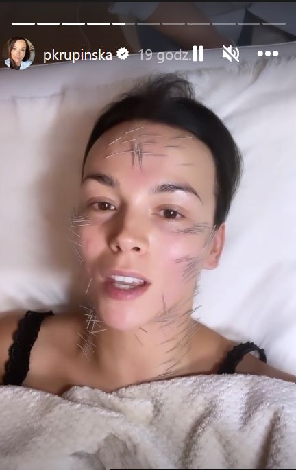 Paulina Krupińska korzysta z zabiegu  needle shaping