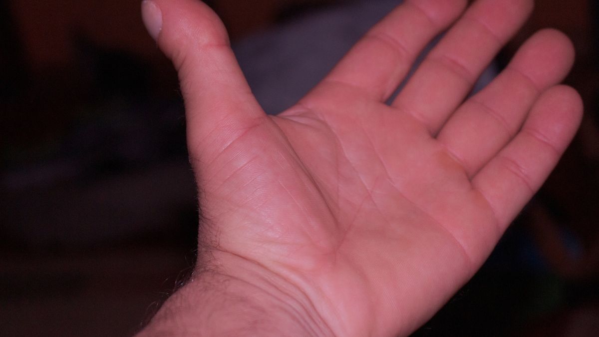 Objaw pojawia się na dłoniach