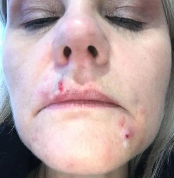 Rany na twarzy po nieudanym zabiegu