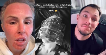Przysmażona laserem Blanka Lipińska nadaje po kolejnym zabiegu: "Nie ma takiego dyskomfortu, który mnie przed tym powstrzyma" (FOTO)