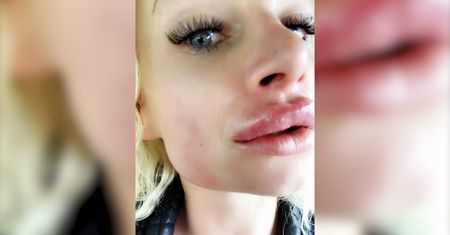Chce wyglądać jak Barbie. Niestety powiększenie ust było nieudane (WIDEO)