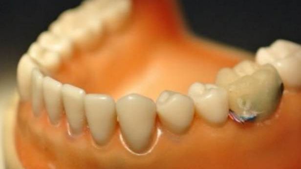 Szpieg w naszych ustach. Tajwańscy naukowcy stworzyli elektroniczny ząb 1