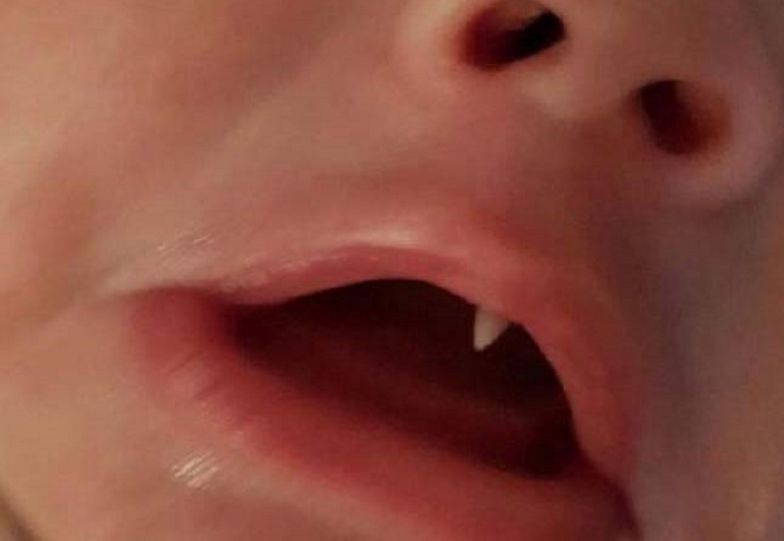 Matka zauważyła dziwny ząb u dziecka. Lekarze rozłożyli ręce
