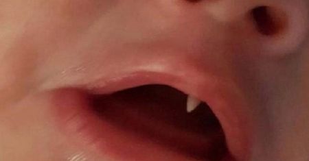 Matka zauważyła dziwny ząb u dziecka. Lekarze rozłożyli ręce