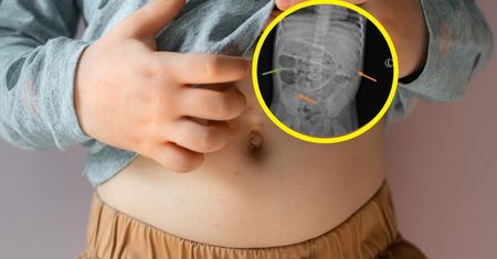 Myśleli, że 3-latek ma zaparcia. W szpitalu odkryli, co znajdowało się w jego jelitach