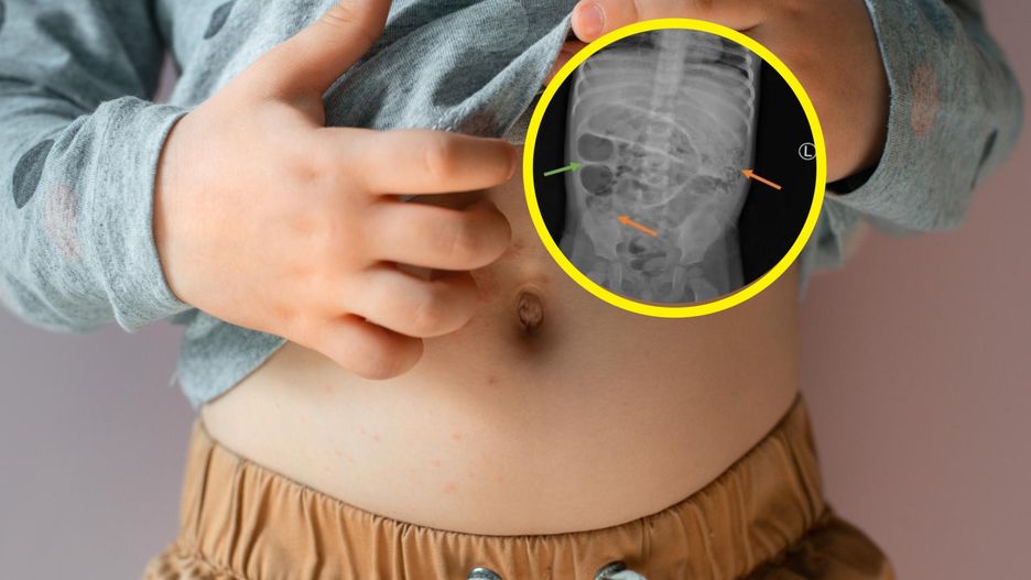 Dziecko skarżyło się na ból brzucha. W jego jelitach odkryli robaki