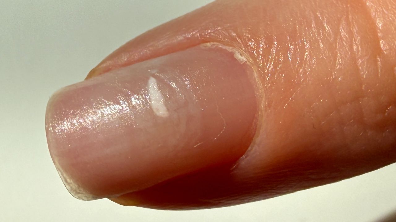 Co oznaczają białe plamki na paznokciach?