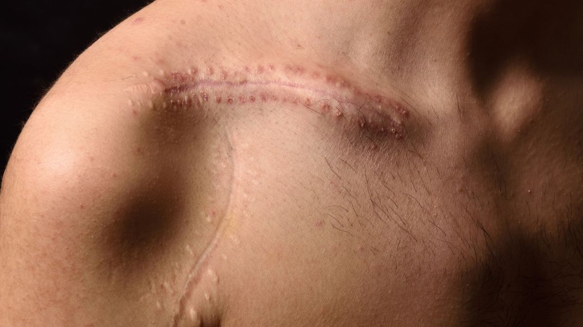 Endermologia może być wykorzystana w leczeniu blizn pooperacyjnych.