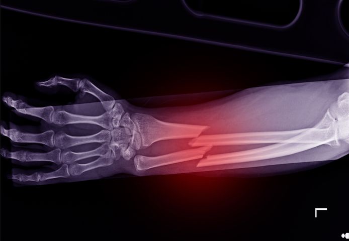 Złamania kości promieniowej powstają zazwyczaj w okolicy trzonu kości bądź w okolicy nadgarstka.
