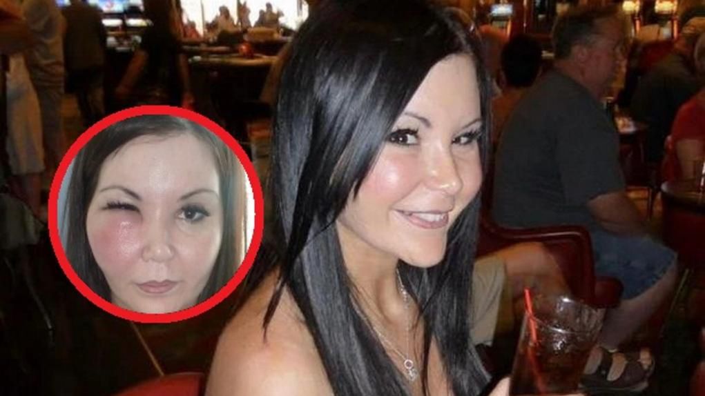 Lekarz zapewniał ją, że zabieg jest bezpieczny, a wypełniacze będzie można usunąć