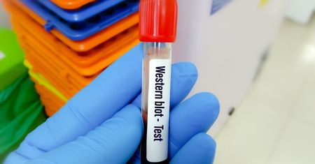 Test Western Blot – wskazania, przygotowanie, przebieg, cena