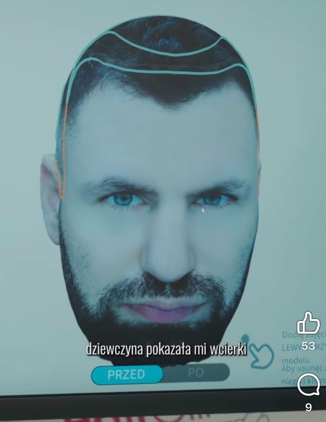 Wojtek Gola zrobił przeszczep włosów