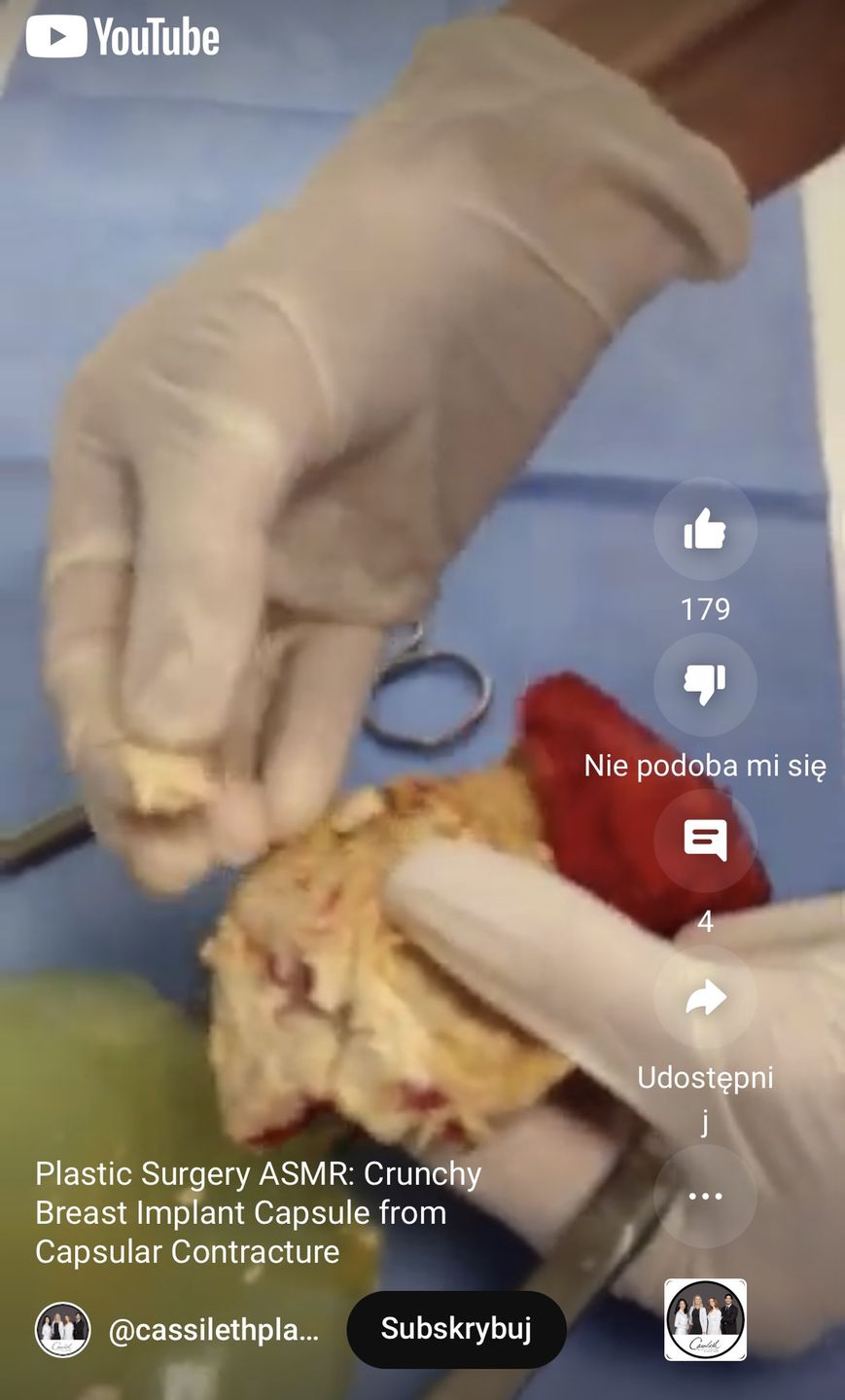 Pokazali, jak wygląda 10-letni implant piersi