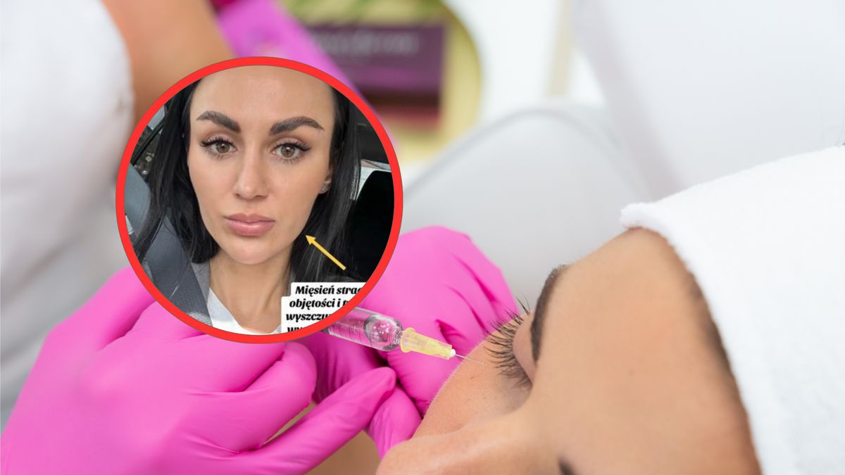 Tiktokerka pokazała konsekwencje wstrzyknięcia botoksu 