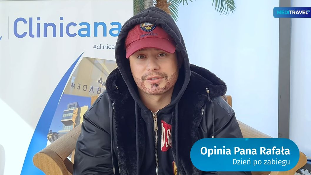 Rafał Collins przeszczepił włosy na brodzie